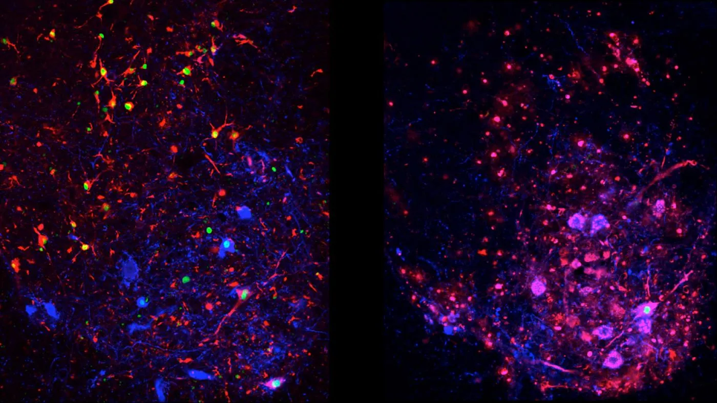 Differences in disease progression in spinal interneurons, a type of nerve cell that generally succumbs to ALS in later stages of disease. Left: Normal ALS models, showing protein aggregation (red/green) in spinal interneurons. Right: autophagy-suppressed ALS models, showing virtually no aggregation (Credit: Tom Maniatis/Columbia's Zuckerman Institute).